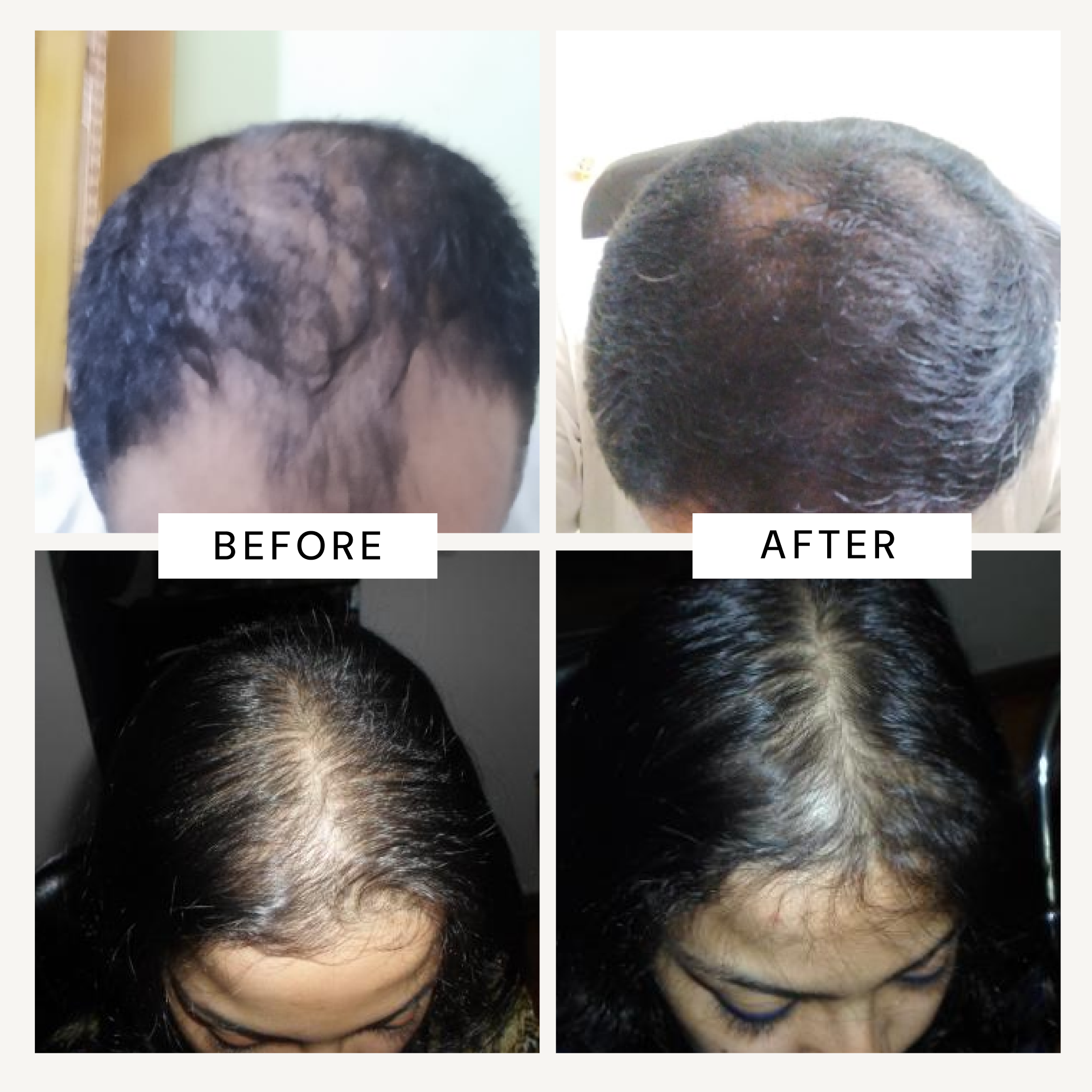 RICHFEEL Scalp Cleanser with Saw Palmetto | Premium Anti-Hair Fall & DHT Blocker Shampoo  (Pack of 3)